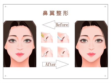 鼻翼缩小怎么做手术