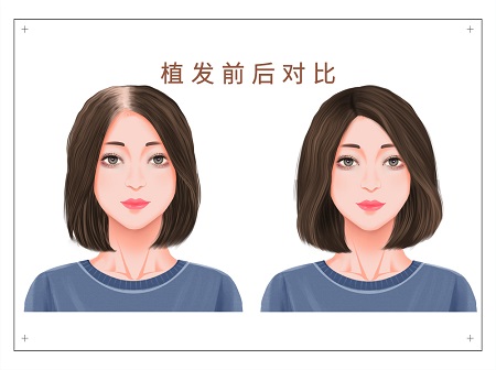 前额头发稀疏如何改善？前额种植头发能保持几年？