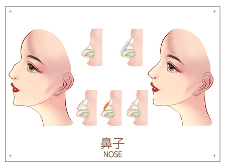 鼻梁增高抬高鼻尖有几种方法？垫鼻尖手术注意事项